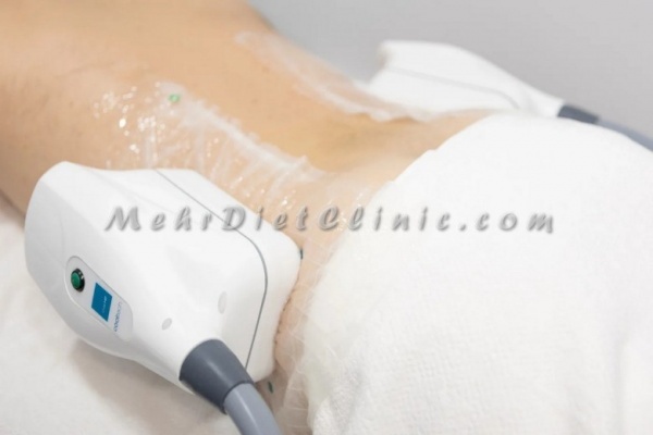 چربی سوزی شکم و پهلو با دستگاه لاغری چربی شکن