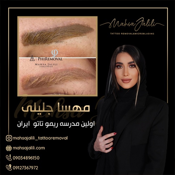 مهسا جلیلی استاد ریموو بدون درد
