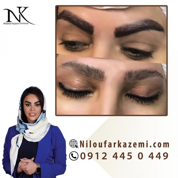 ریموو تاتو ابرو با به کارگیری روش های نوین