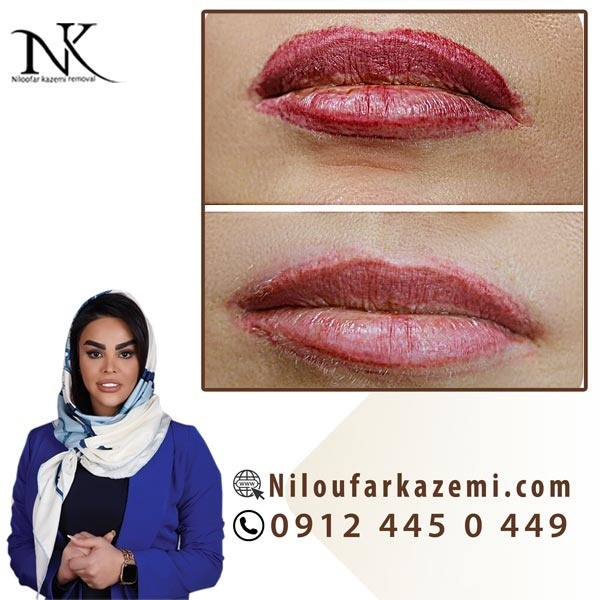 ریموو تاتو خط لب بصورت پیشرفته
