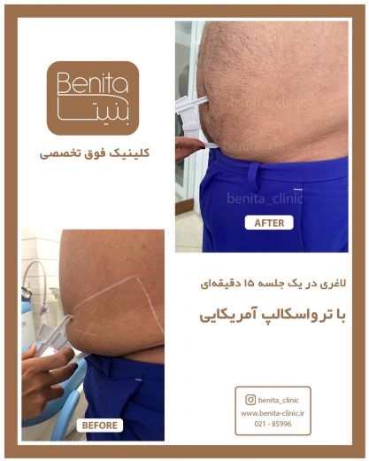 قیمت لاغری با ترواسکالپ