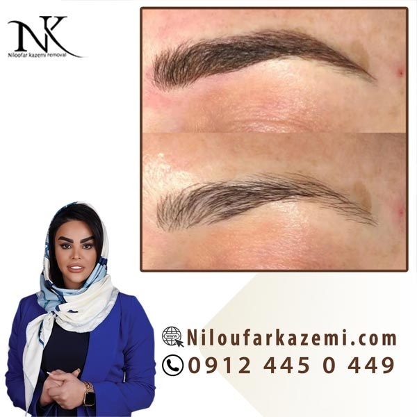 آموزش ریموو تاتو قدیمی با ارائه مدرک